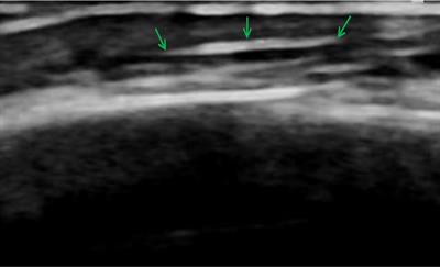 Case Report: A report on the countermeasures after the rupture of the scalp venous indwelling needle catheter in 12 cases